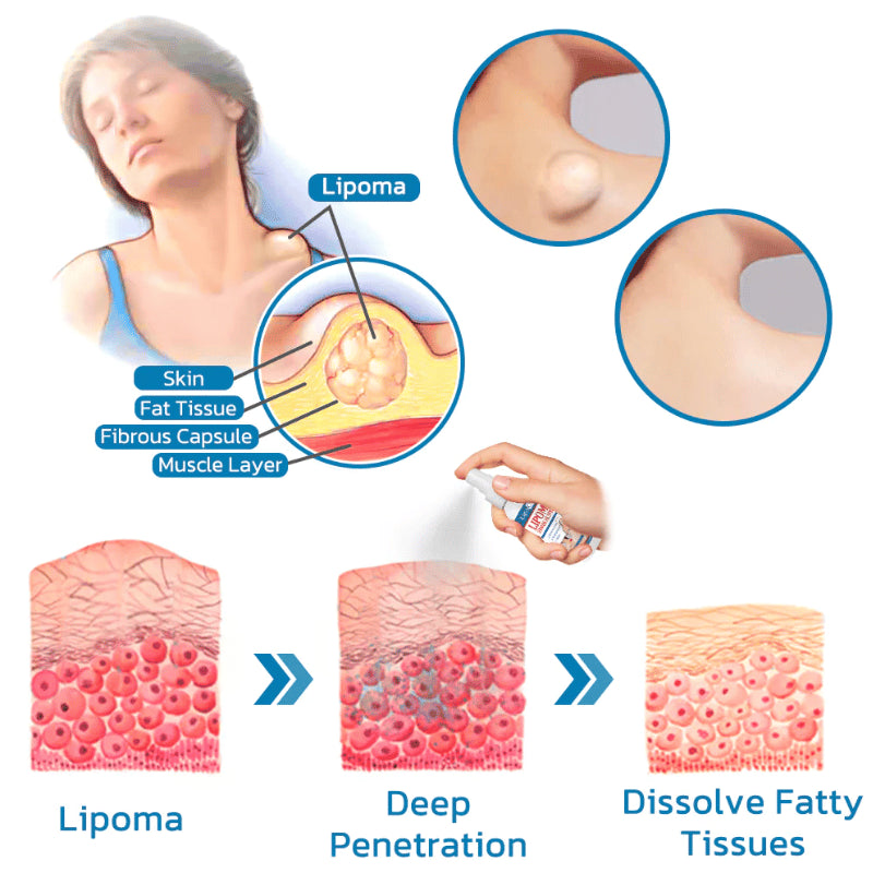 LIPO-OUT (SPRAY ELIMINACION DE LIPOMAS) X1 UND XPA1 (CARRITO)